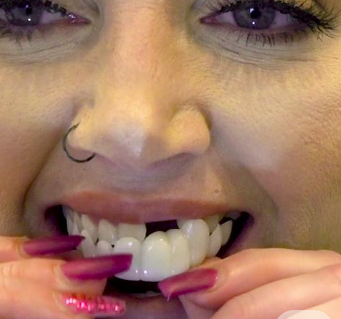 Daily-Life-with-a-Removable-Bridge