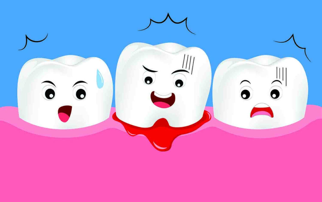 How-to-Stop-Bleeding-After-Tooth-Extraction