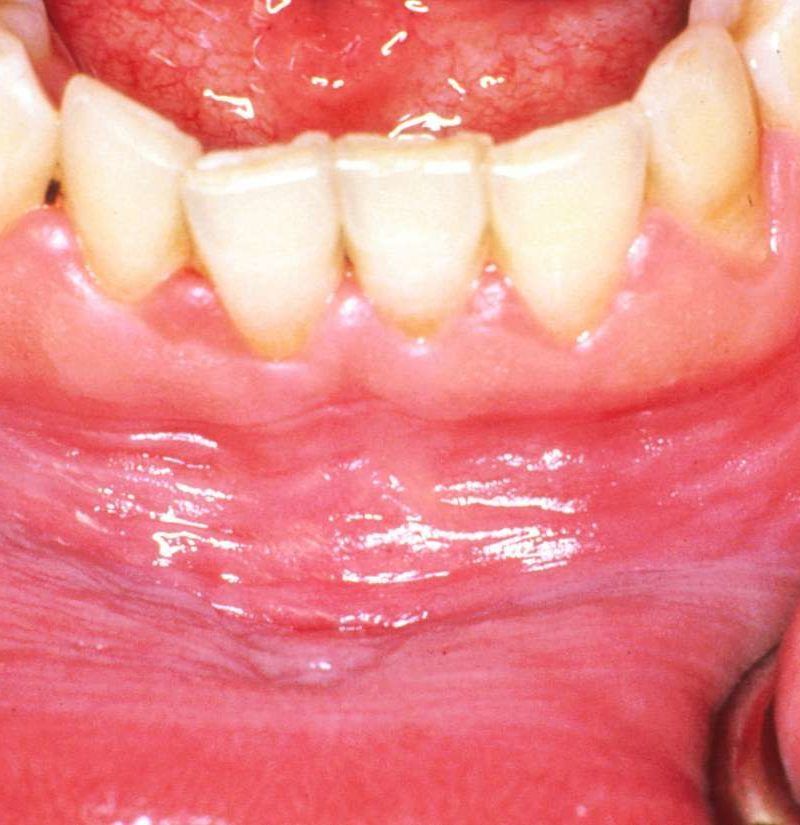 causes-of-white-color-on-gums