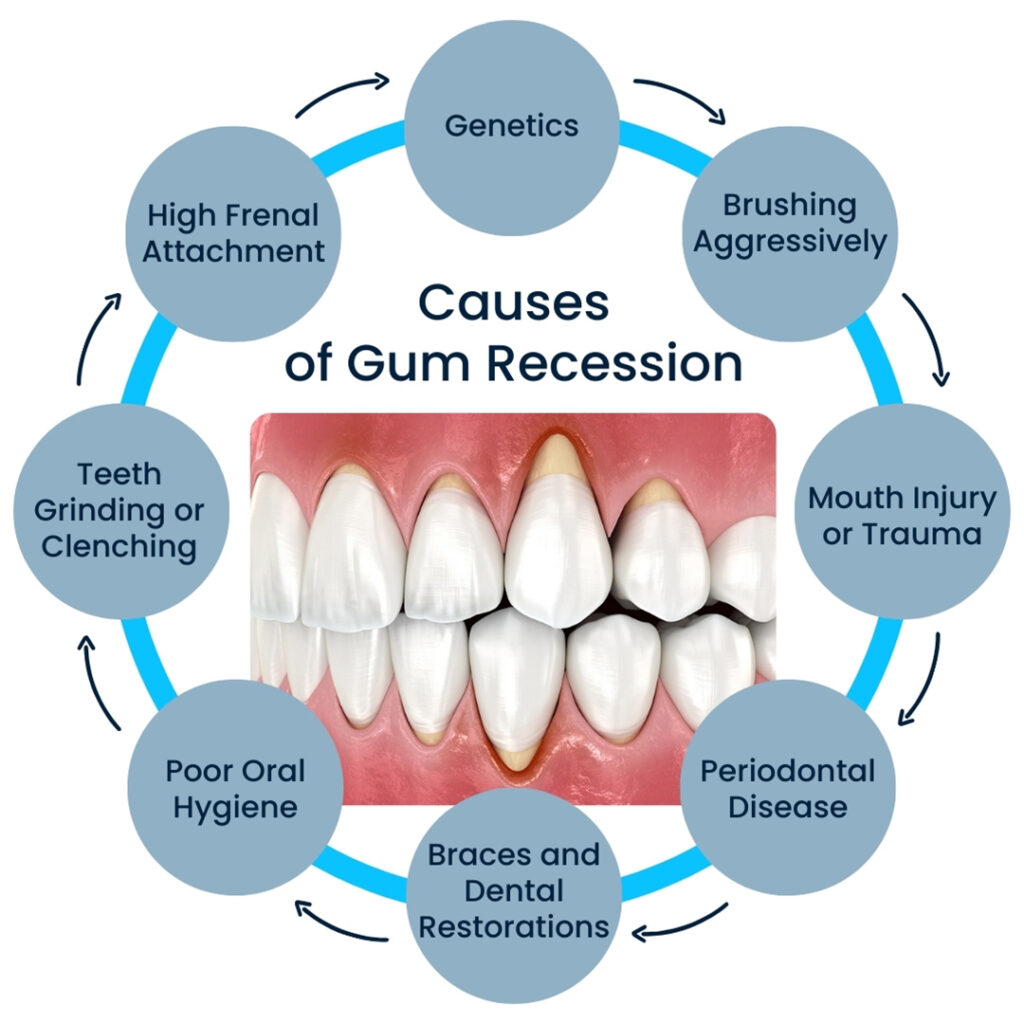 What-is- Gum-Recession-and-its-causes