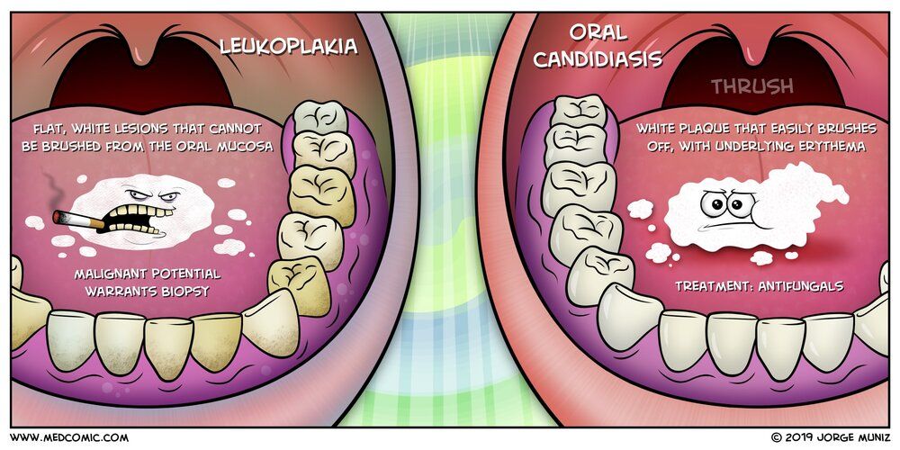 Leukoplakia-vs-Oral-Thrush
