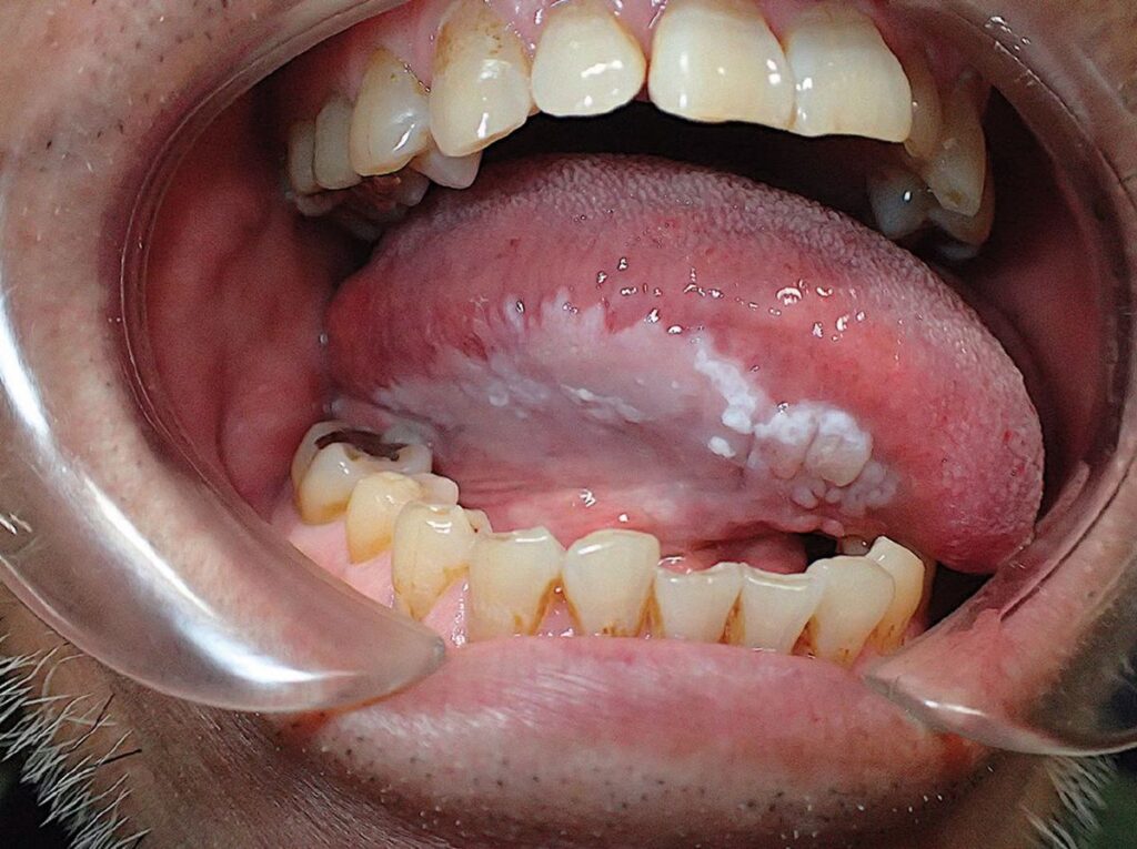  Leukoplakia