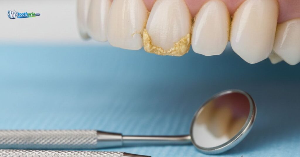 calculus_teeth_causes_risks_and_safe_removal_methods_showing_tartar_buildup_on_teeth