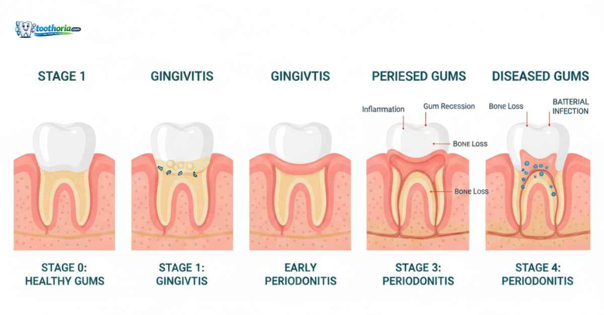 gum-diseases-causes-symptoms-stages-effective-treatments