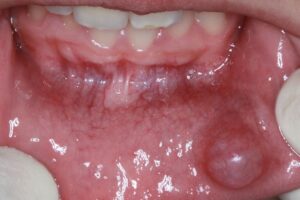 blood-blister-vs-melanoma