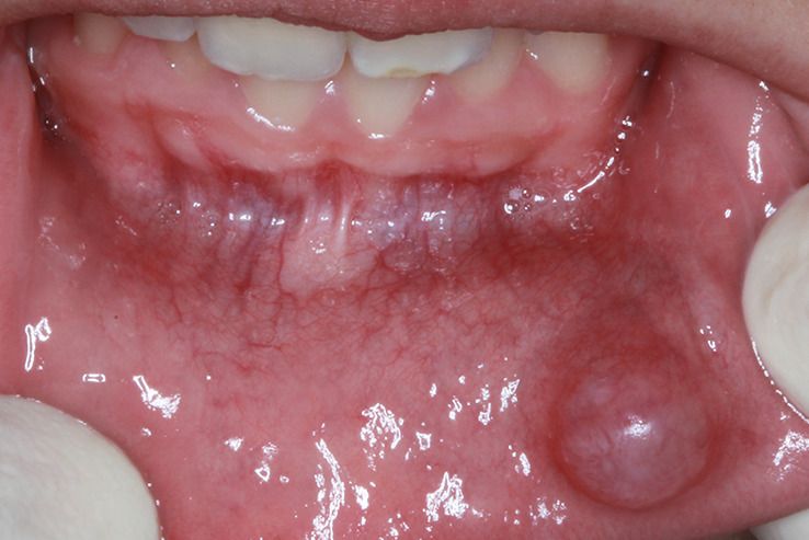 blood-blister-vs-melanoma