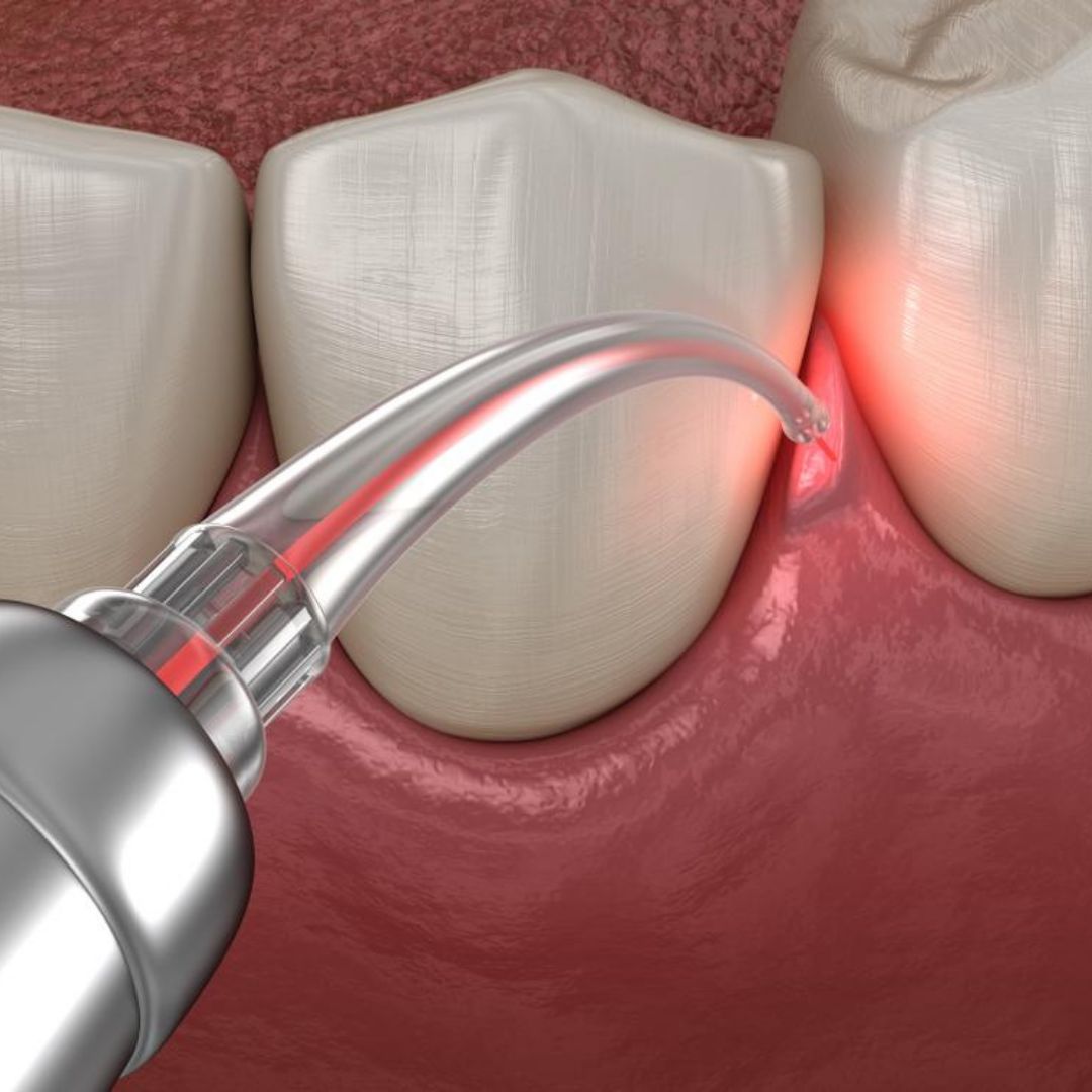 best-antibiotic-for-gum-infection