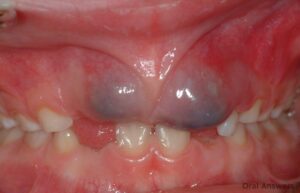 Gum-Cyst-vs-Blood-Blister
