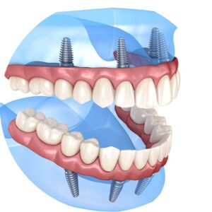 Dental-Implants-Cost-2026-Real-Prices-Revealed