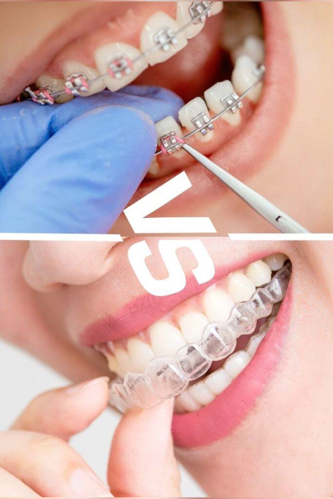 Invisalign-vs-Braces