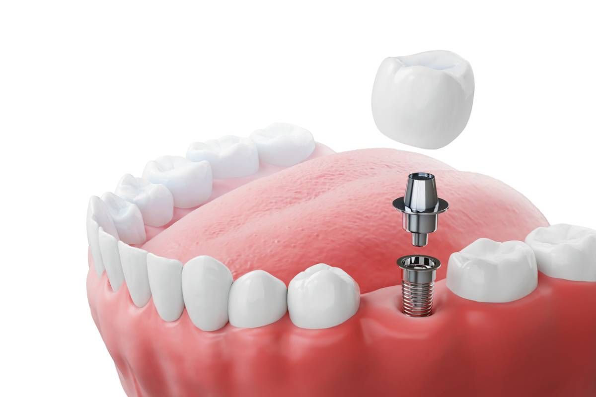 screwless-dental-implants