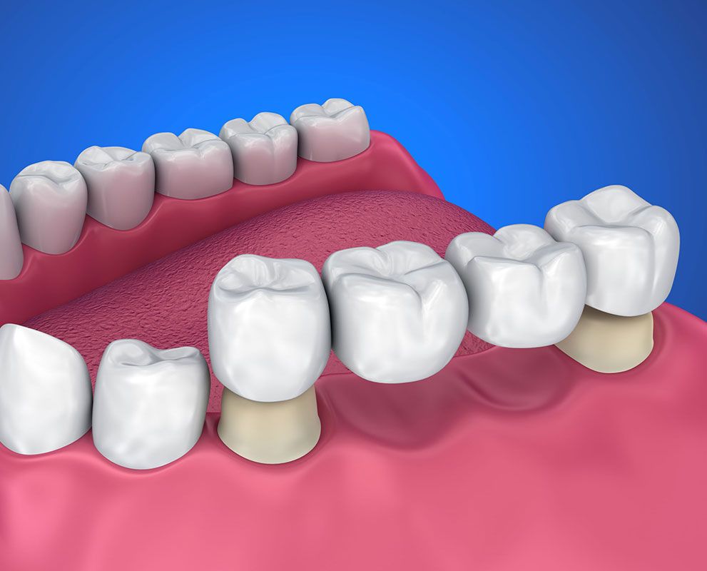 dental-bridge-cost