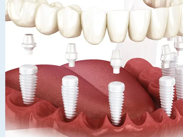 Understanding-Zirconia-Tooth-Implant-Cost-Fundamentals