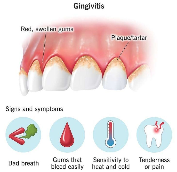 Understanding-Gum-Infections-and-When-Antibiotics-Are-Needed