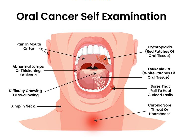 What-Is-Oral-Melanoma