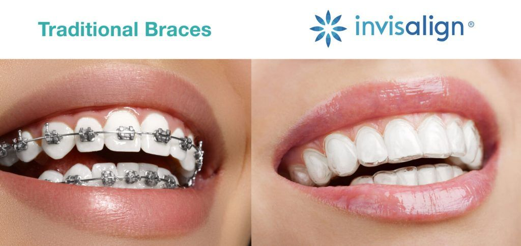 Invisalign-vs-Braces-Cost-Comparison