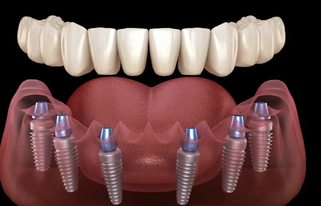 full-mouth-implant