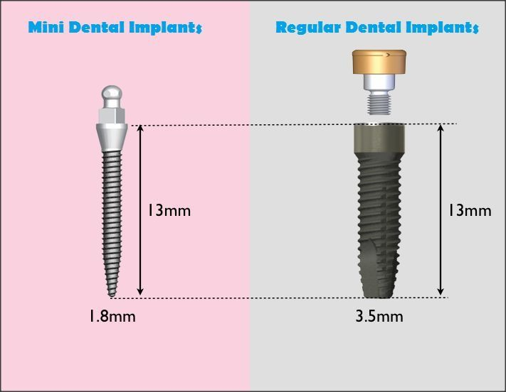mini-vs-regular-dental-implants