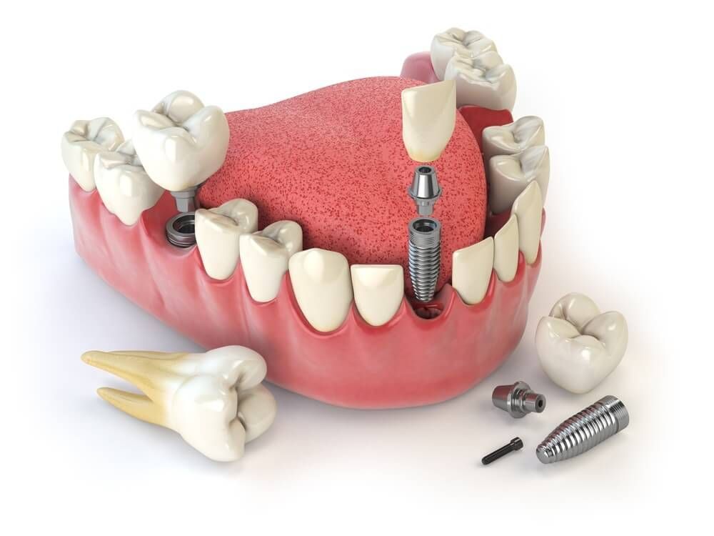 What-Exactly-Is-a-Screwless-Implant-cost?