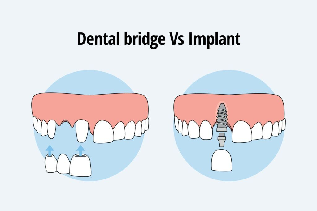 Comparing-Bridges-to-Other-Replacement-Options