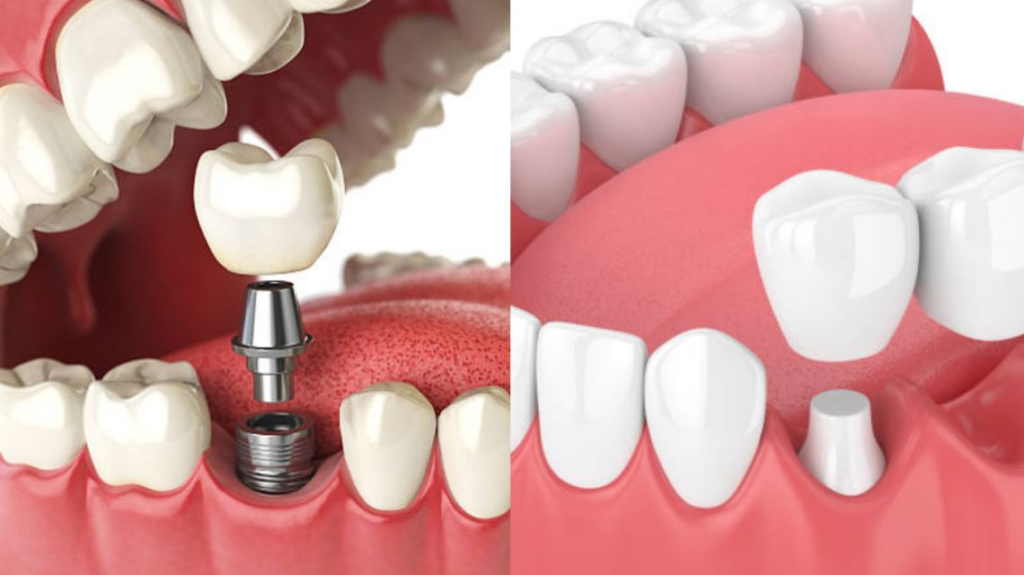 Types-of-Single-Tooth-Removable-Bridges