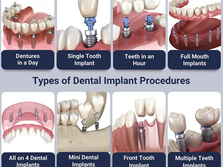 How-Much-Do-Dental-Implants-Cost-for-Different-Scenarios