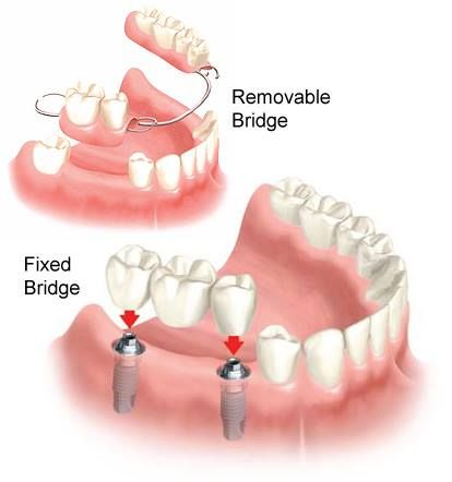 dental-bridge-cost-by-type
