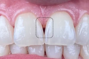 black-triangle-teeth