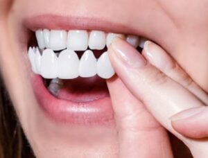 smile-makeover-cost