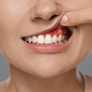 white-color-on-gums-causes-&-symptoms