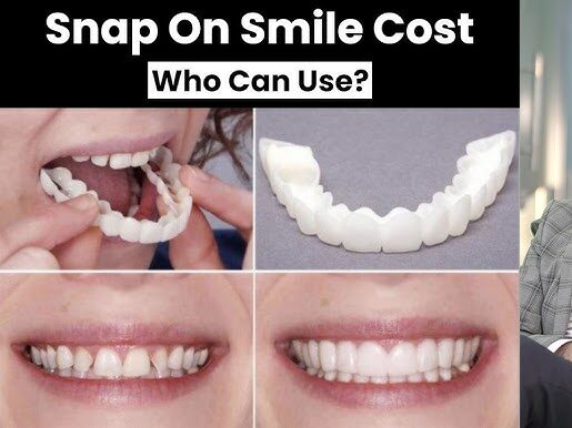 cost-of-snap-on-veneers