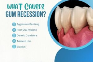 What-Is-Gum-Recession