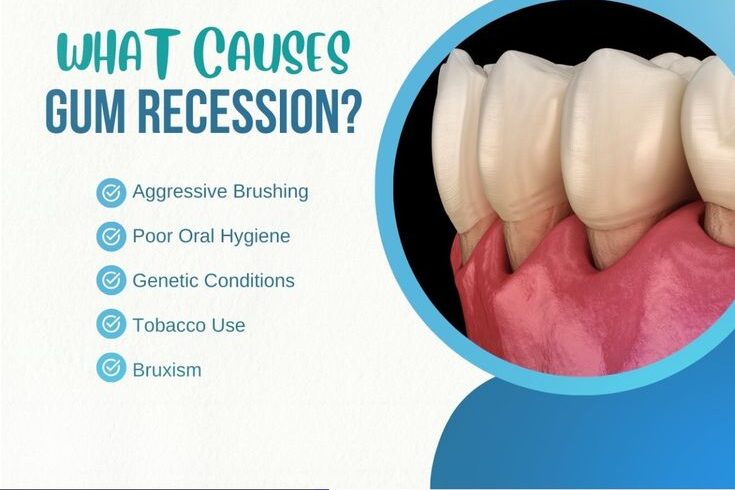 What-Is-Gum-Recession