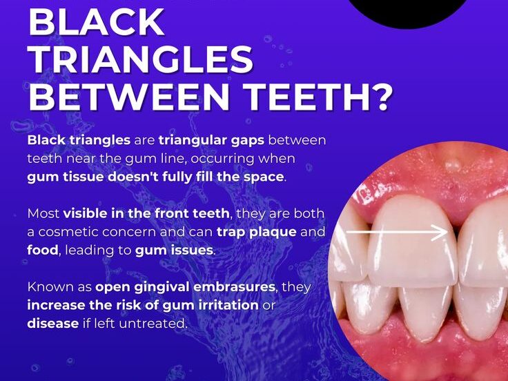 what-are-black-triangle-teeth