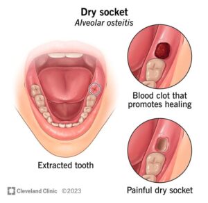 Dry-socket-home-remedies