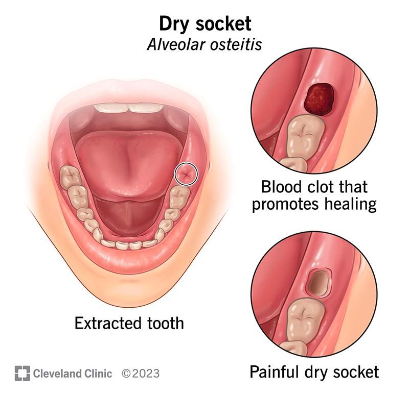 Dry-socket-home-remedies