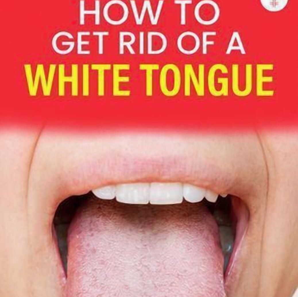 How-to-Prevent-White-Blemish-on-Tongue
