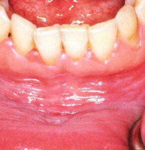treatment-options-for-white-color-on-gums