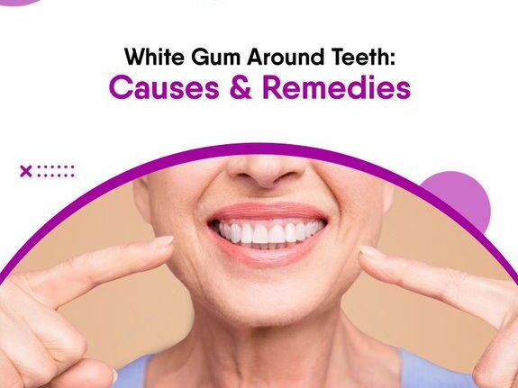 treatment-options-for-white-color-on-gums