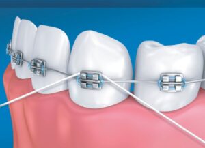 floss-dental-implant